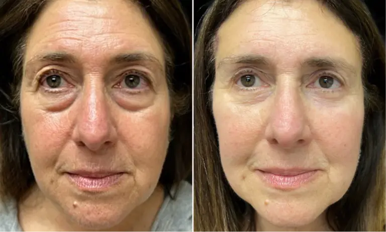Renewa EyeLift Review