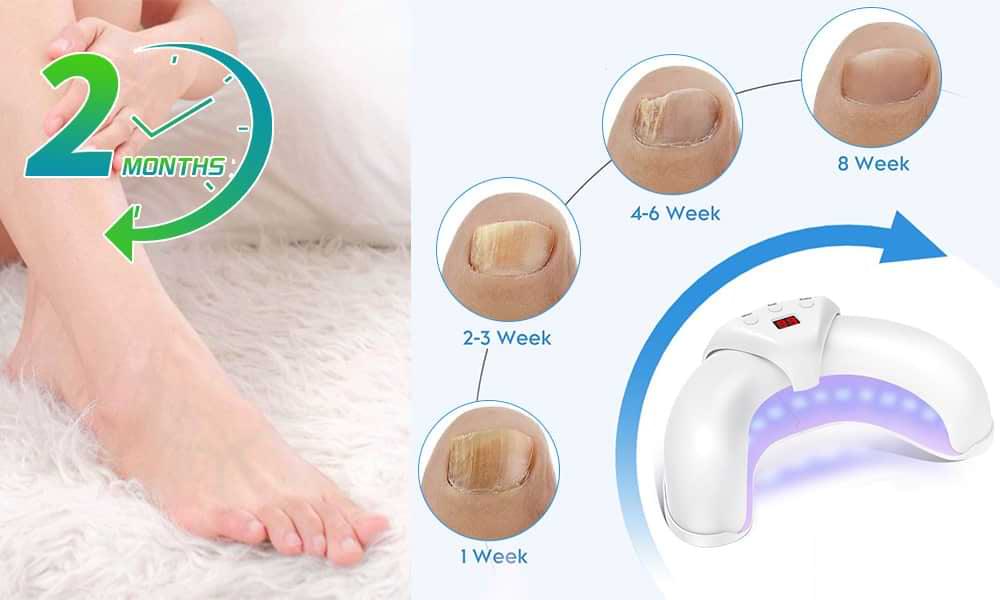 Welnax BioClear Toenail Fungus Device Review 2